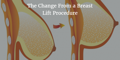 Breast Lift Surgery Beverly Hills - Mastopexy Los Angeles