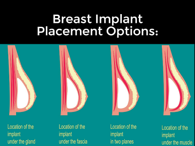 Colocação de implantes mamários